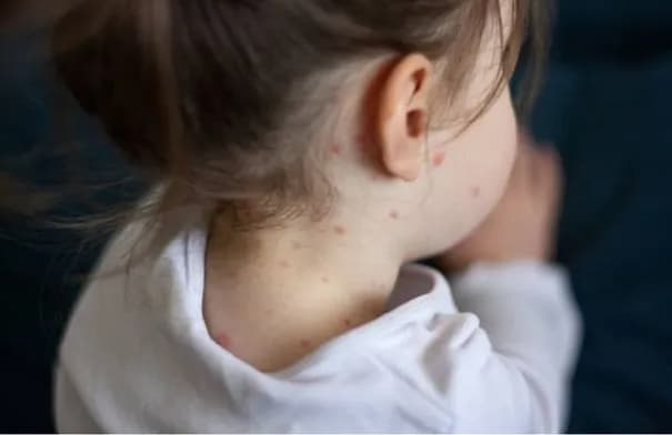 تحذيرات من تفشٍ عالمي للحصبة مع توقعات بتسجيل 11 مليون إصابة