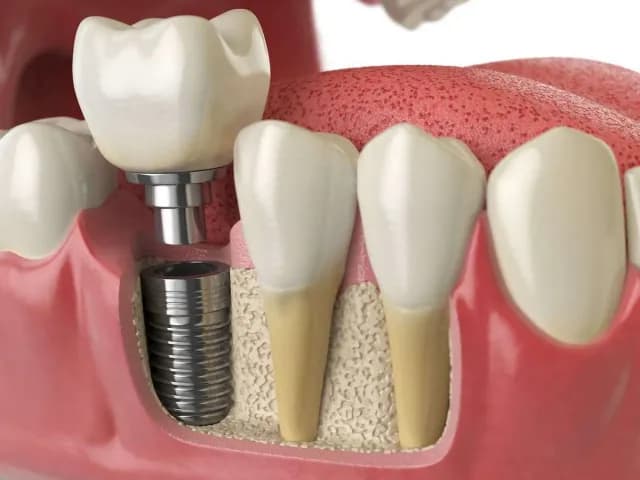 إعلانات زراعة الأسنان في الأردن: هل يضلل المريض إخفاء العلامة التجارية؟